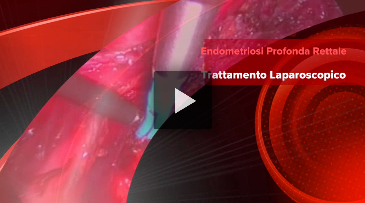Endometriosi profonda rettale. Trattamento Laparoscopico