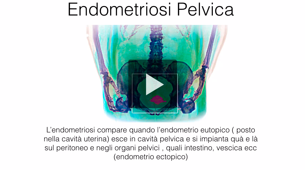 Endometriosi pelvica