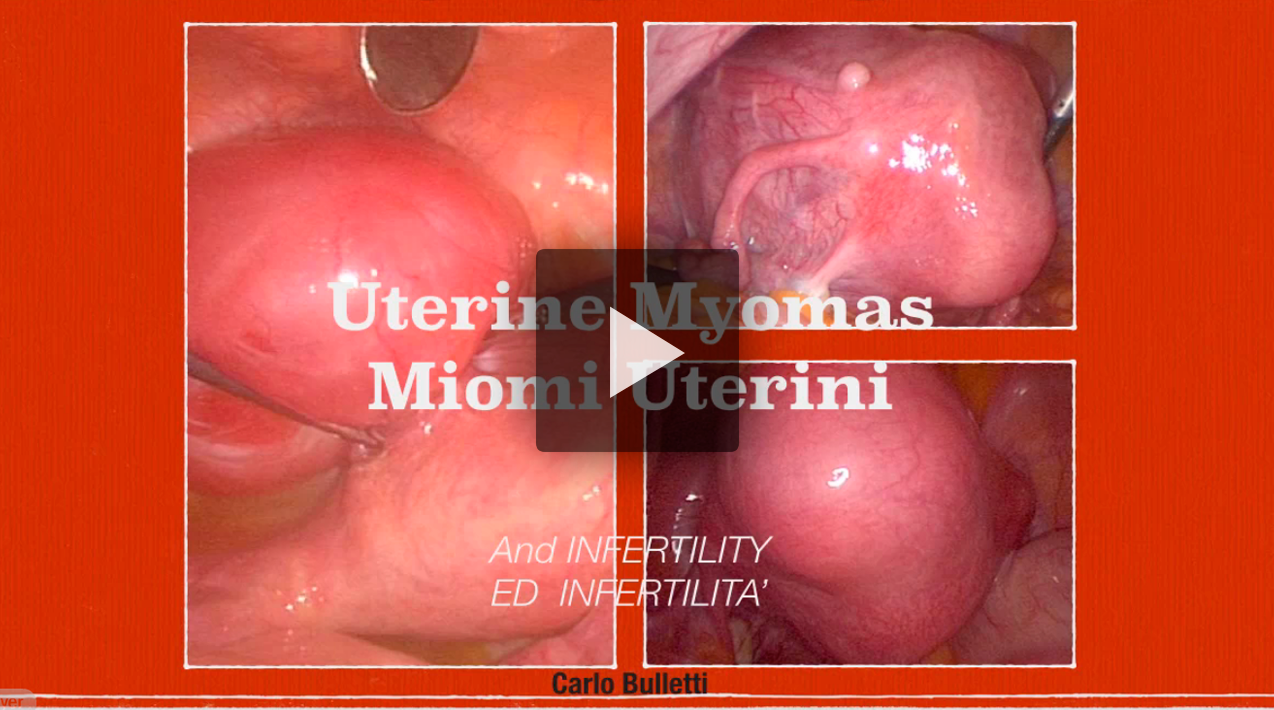 Miomi uterini